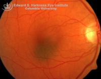 Choroidal Nevus